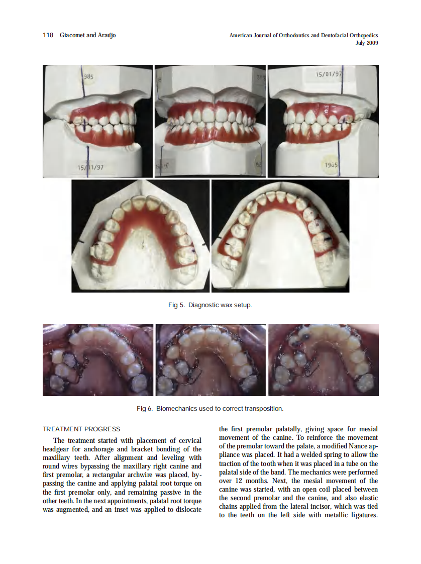 Giacomet_Orthodontic-correction-of-a-maxillary-canine-first-premolar-transposition_2009.pdf 第4页