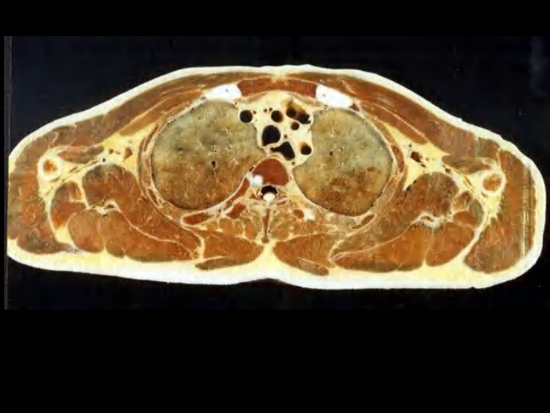 07 纵隔连续横断层解剖及CT.pdf 第3页
