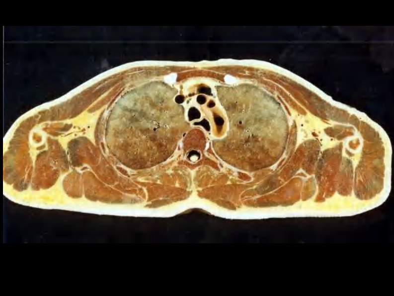 07 纵隔连续横断层解剖及CT.pdf 第4页