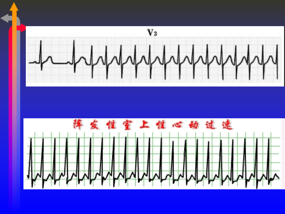 心电图－第五次课（心律失常二）.ppt 第5页