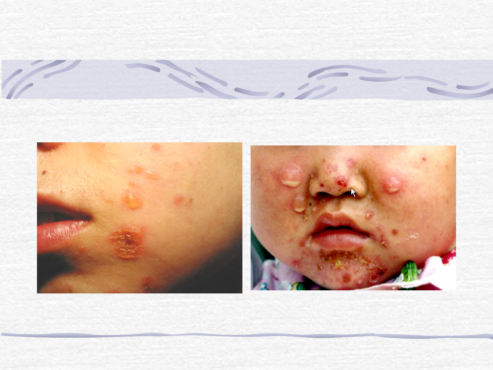 3)春季放射口腔病毒、细菌性皮肤病-新.ppt 第4页