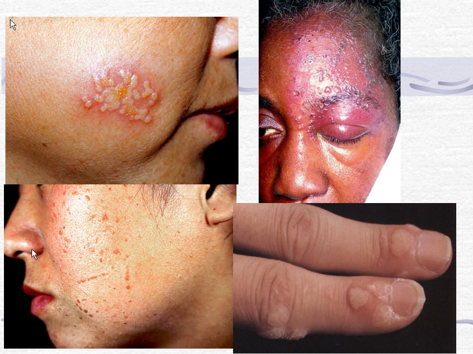 3)春季放射口腔病毒、细菌性皮肤病-新.ppt 第3页