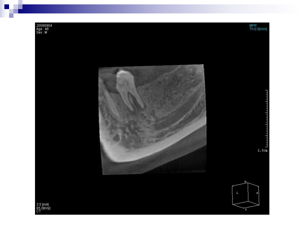 口腔3D影像在口腔种植中的应用.ppt 第5页