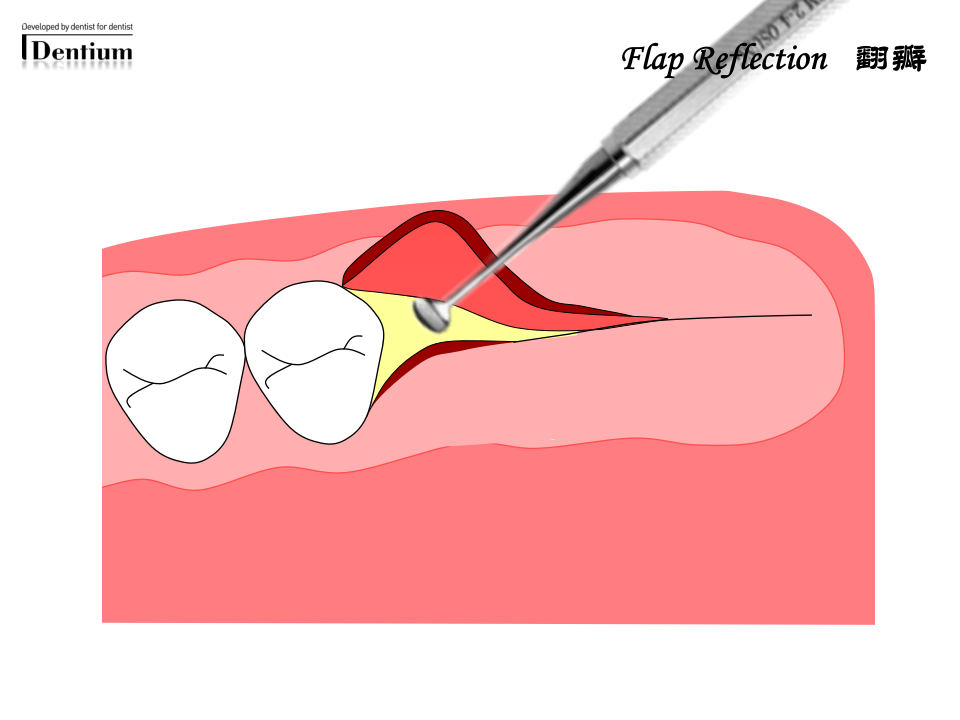 口腔-登腾种植手术指南-淄博口腔医院.ppt 第5页