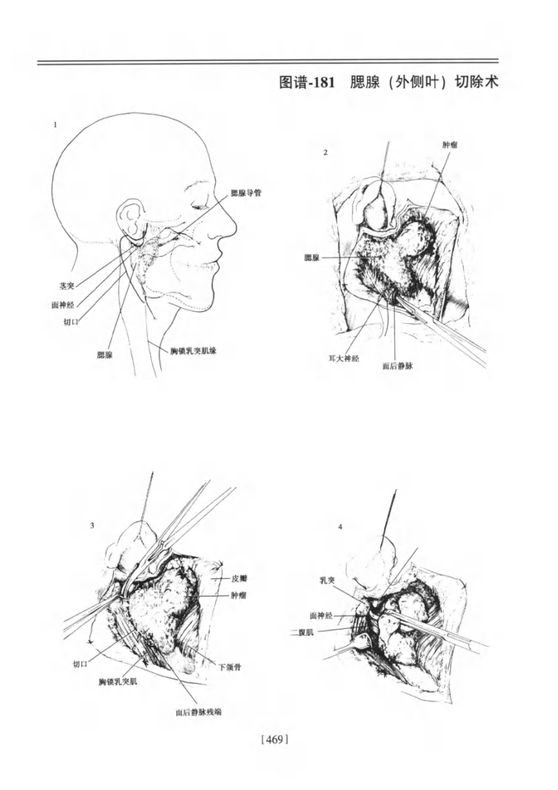 腮腺－提取自佐林格外科手术图谱.pdf 第2页