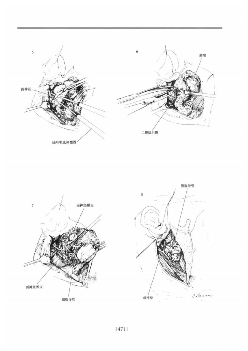 腮腺－提取自佐林格外科手术图谱.pdf 第4页