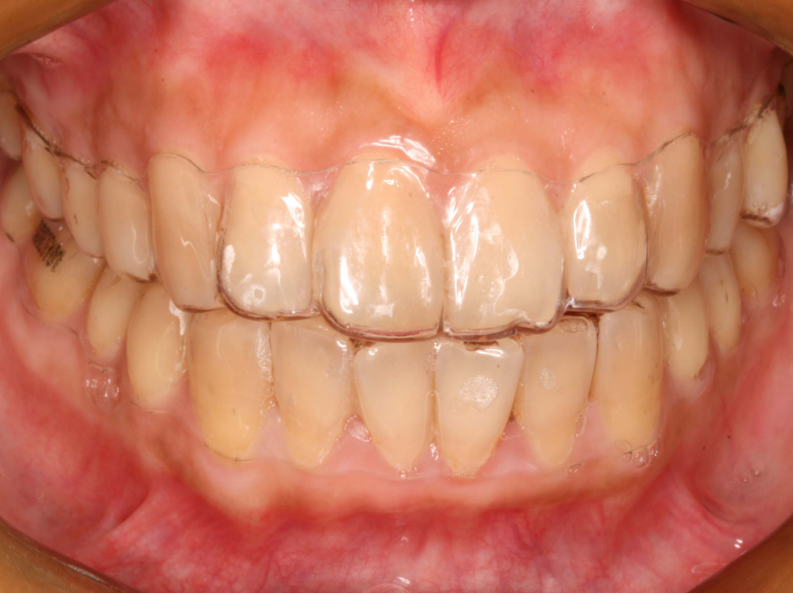 178隐形正畸临床体会.pdf 第4页