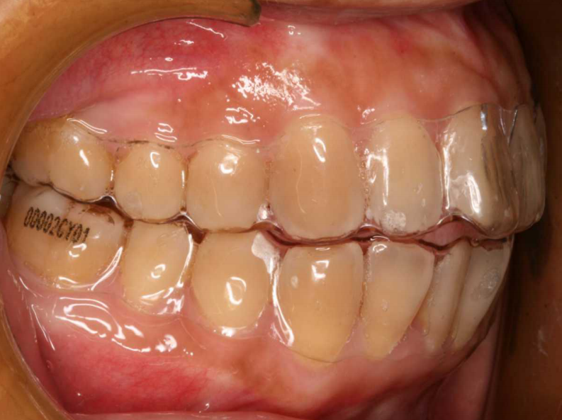 大川分享_隐形正畸临床体会.pdf 第5页