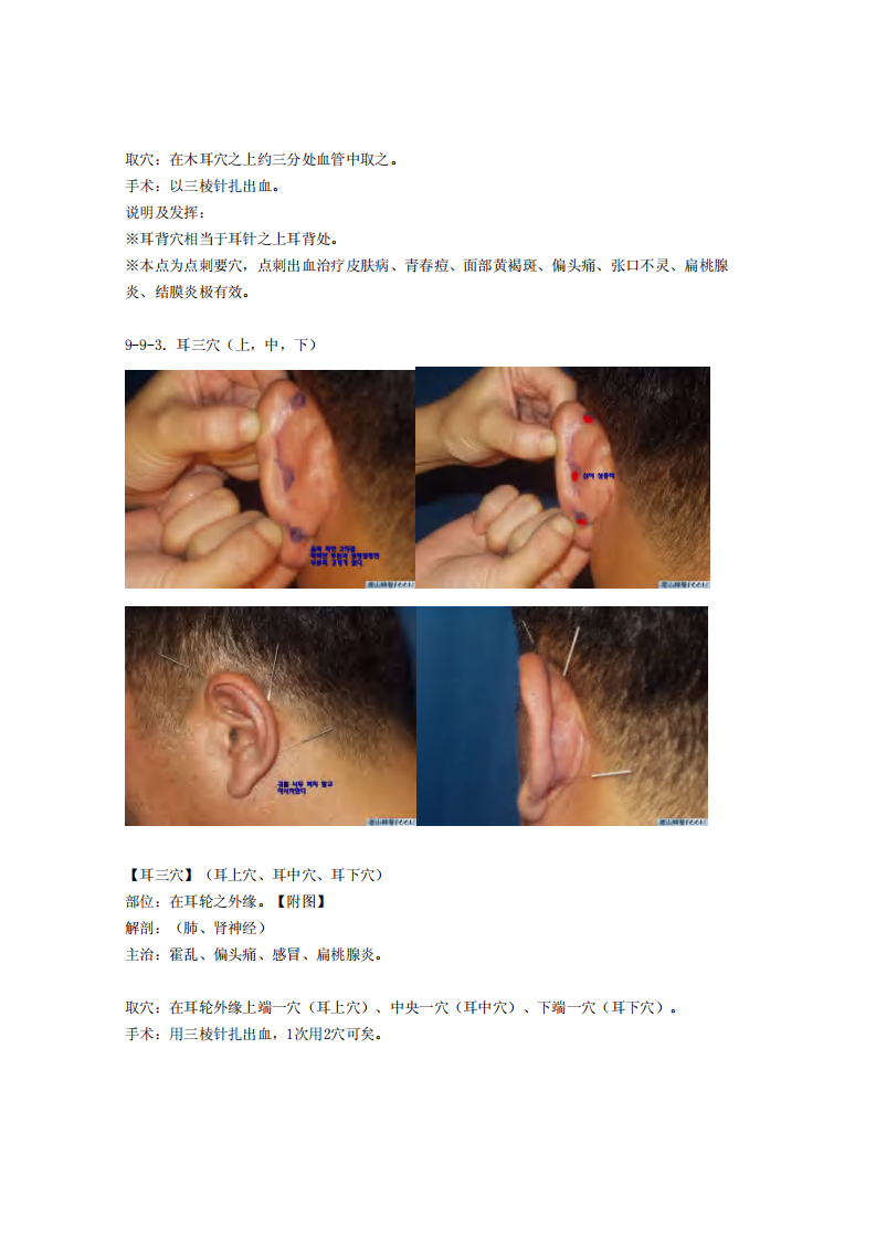 童氏奇穴发挥整理9-9.pdf 第2页