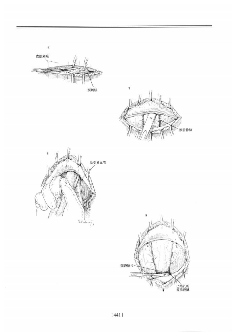 甲状腺及颈清--提取自佐林格外科手术图谱.pdf 第5页