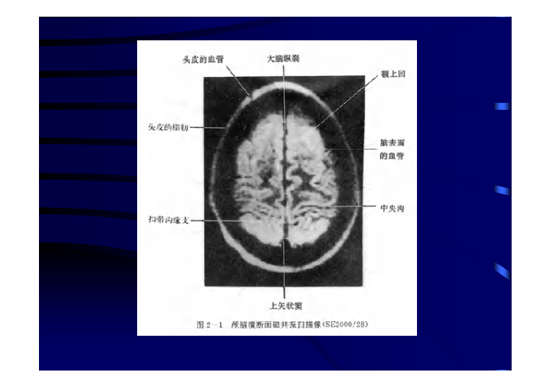 颅脑CT、MRI.pdf 第4页