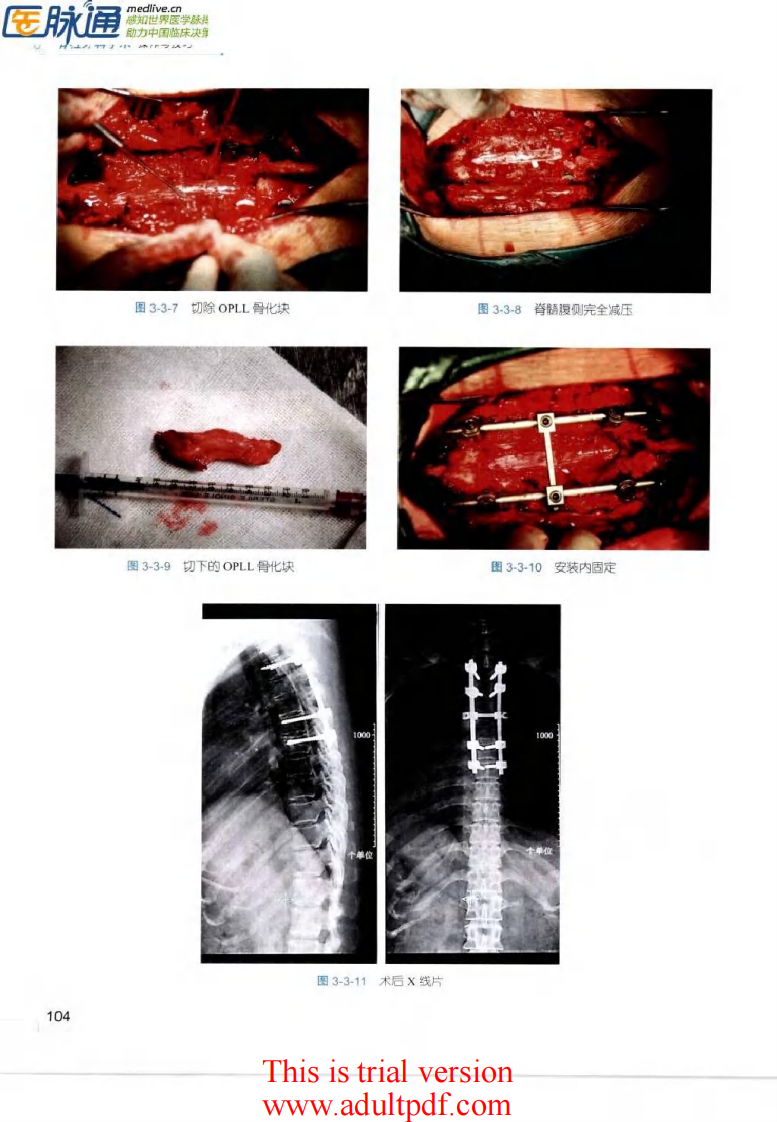 脊柱外科手术操作与技巧（骨科手术技巧丛书）3.pdf 第5页