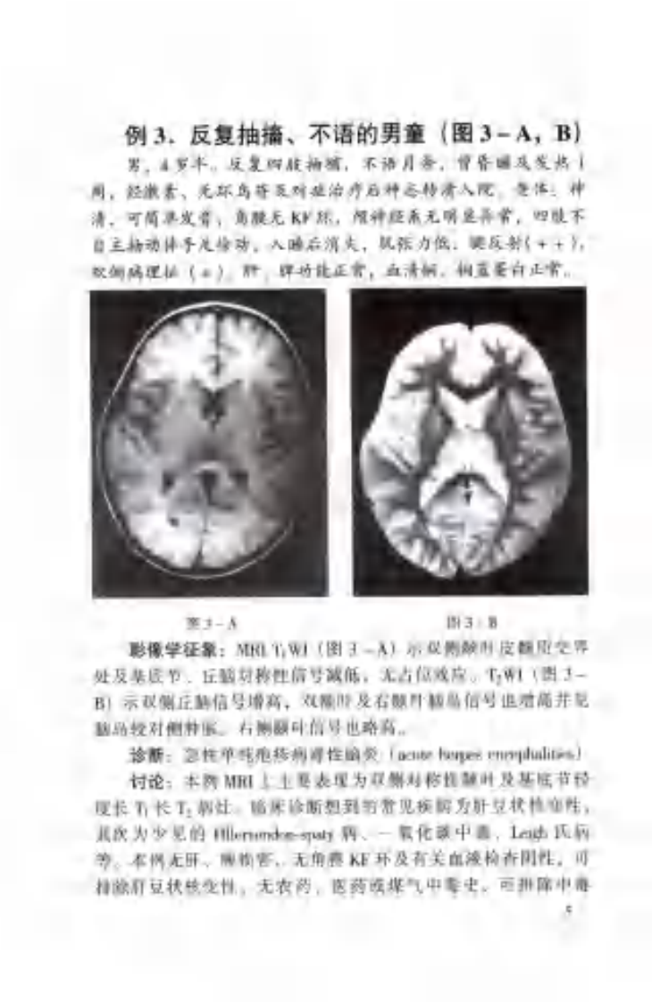 神经科疑难病例影像诊断分析（扫描版）.pdf 第5页