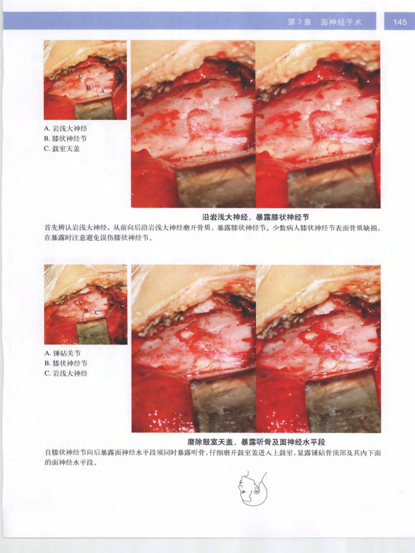 耳显微外科立体手术图谱2.pdf 第5页