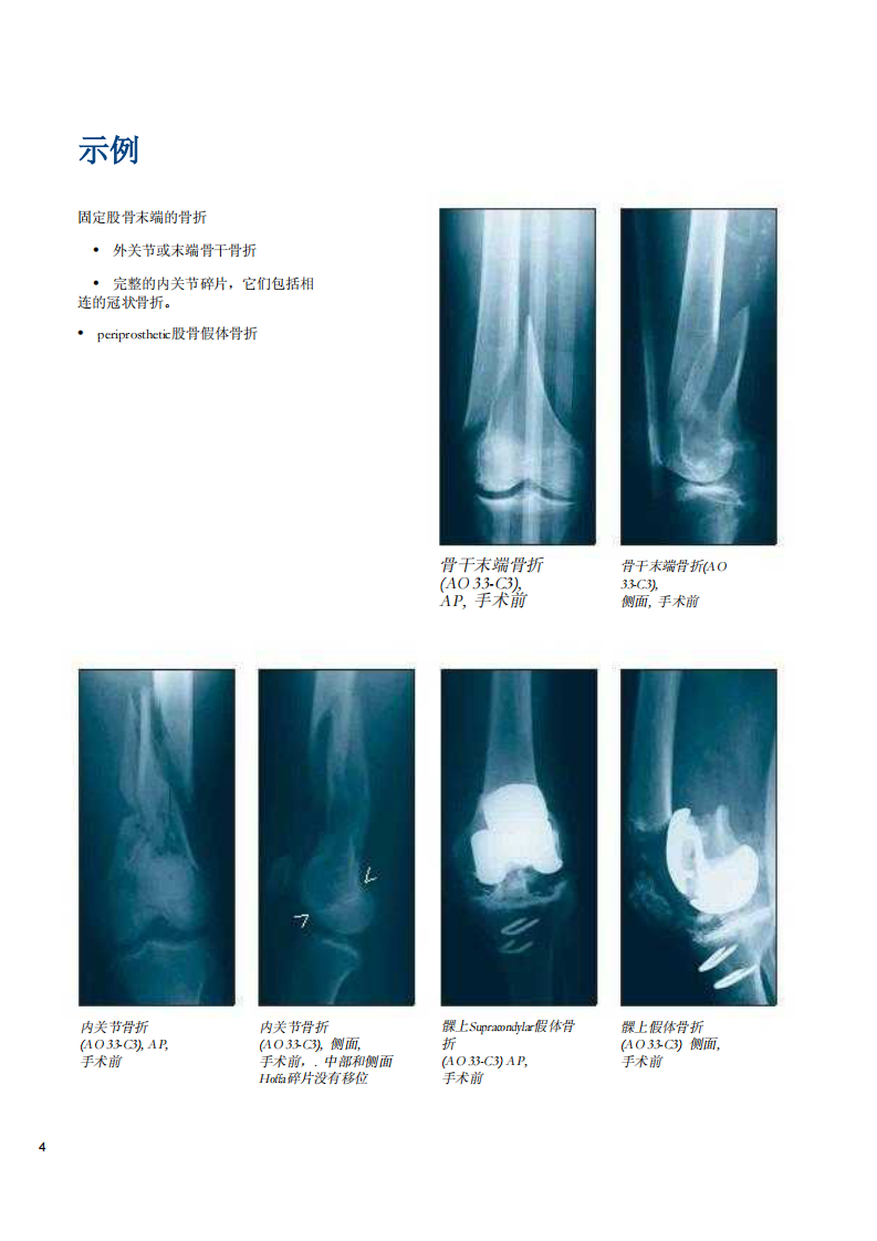 AO-LISS钢板系统固定技术详解.pdf 第5页